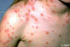 Illustration for article titled obat herpes manjur